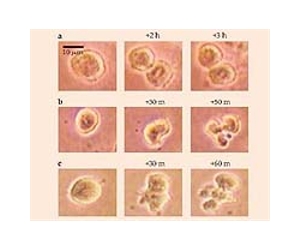 Biomarker MIA shows presence of neurofibromas