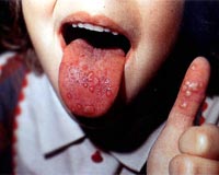 Toll in China disease outbreak rises to 31 children