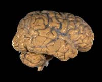 New Method Holds Promise For Treating Brain Injuries