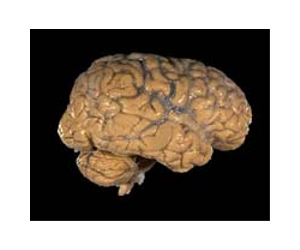 New brain scan better at detecting early Alzheimers