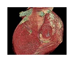Intermountain Medical Center reseachers develop new 3-D technology to treat atrial fibrillation