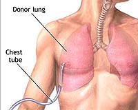 Swine flu virus linked to more lung damage: lab study