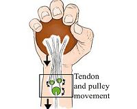System designed to improve hand function lost to nerve damage