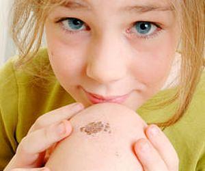 Human scabs serve as inspiration for new bandage to speed healing
