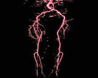 GPS Tracker May Better Gauge Severity Of Peripheral Artery Disease