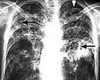 Can Government Force TB Treatments