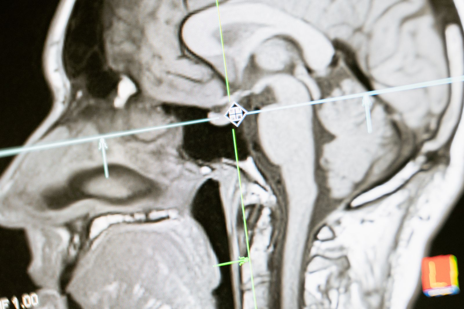 intervertebral disc MRI